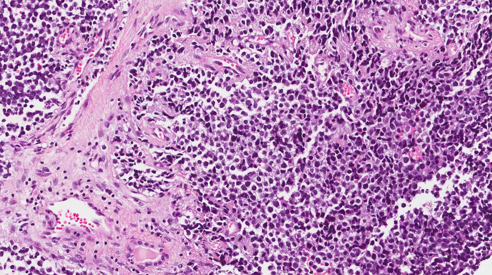 typical microscopic appearance of rhabdomyosarcoma