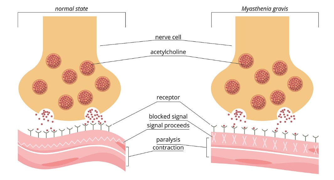 Myasthenia Gravis